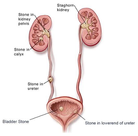 MALFUNCTIONING OF KIDNEYS
